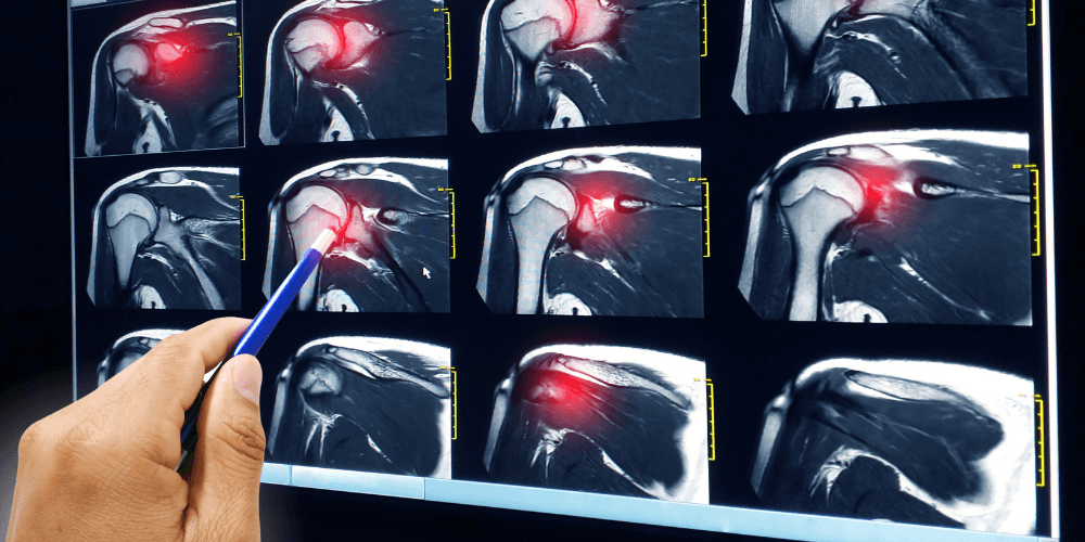 X-ray scan results of a rotator cuff injury.