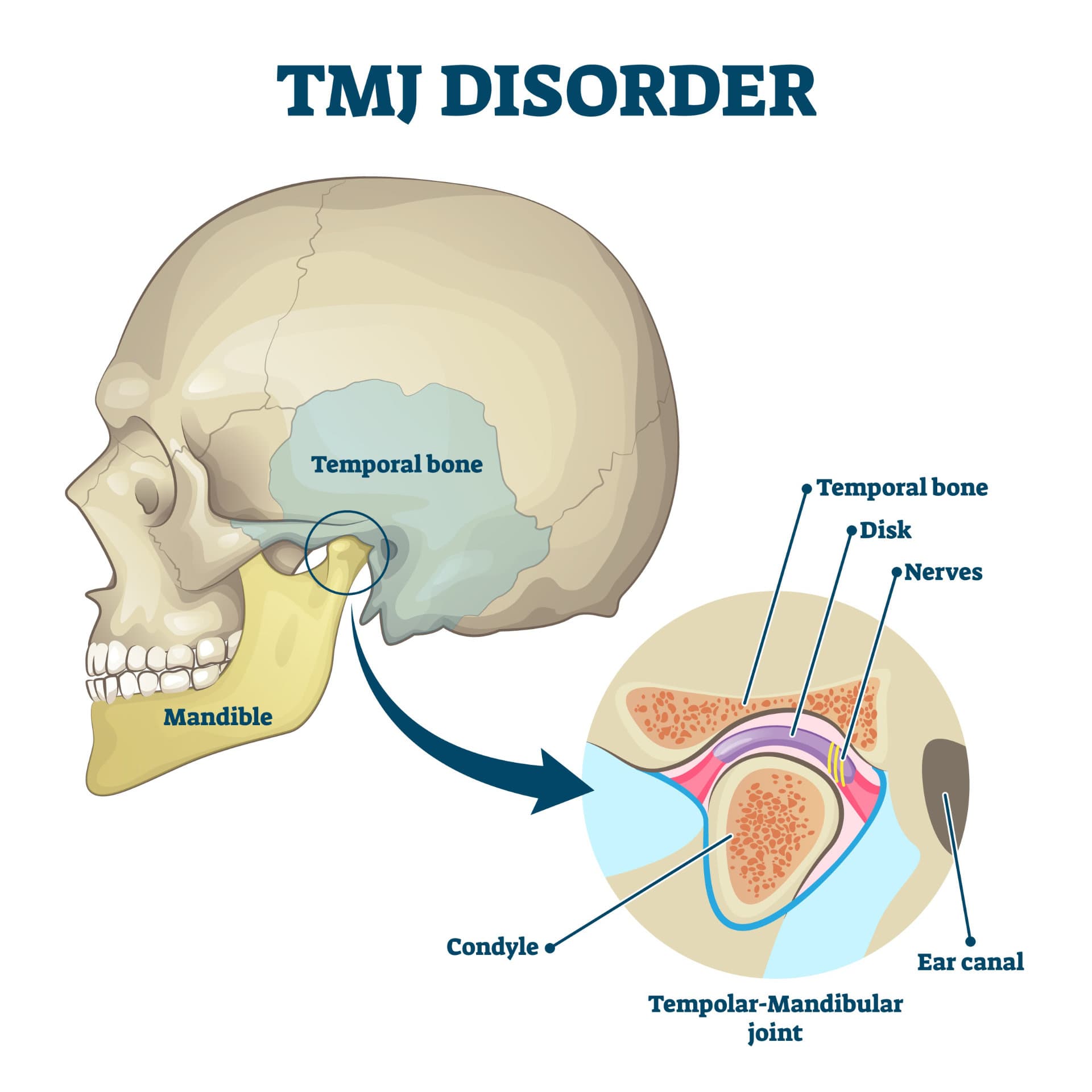 Diagram showing the anatomy of the temporomandibular joint, used to explain TMD and jaw pain to physical therapy patients in Bend, Oregon.